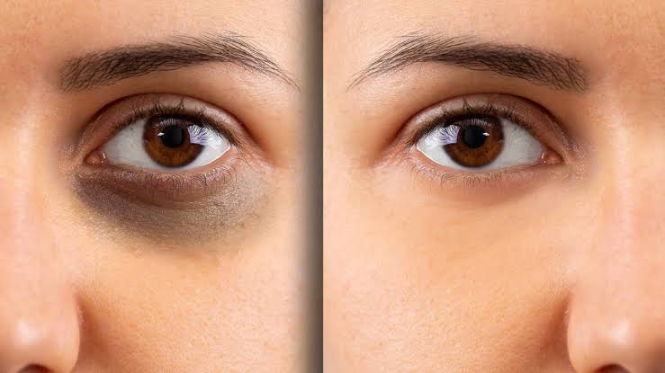 Home remedies for Dark circles: वर्षों पुराने डार्क सर्कल दूर करने की निंजा टेक्नीक