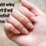 white spots on nails: अगर आपके नाखूनों पर भी हैं सफेद धब्बे, तो हो जाइए सतर्क! इन छोटे सफेद धब्बों में छुपे हैं कई बड़ी बिमारियों के राज